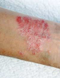 Nurse Nursing Career Risks Dermatitis